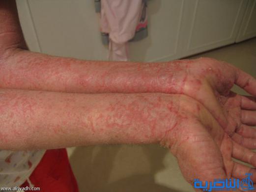 الناصرية تسجل اول اصابة بمرض جلدي نادر قد يودي بحياة صاحبه