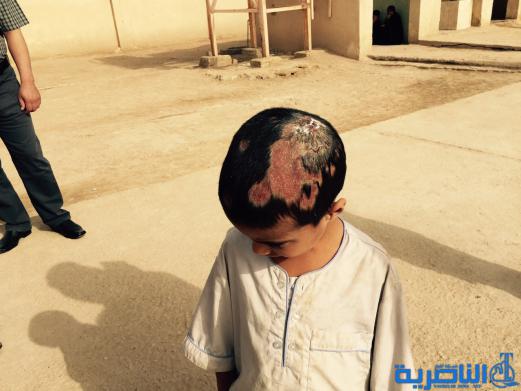 بعد نشره على الشبكة ،صحة ذي قار توفد فريقا الى الاصلاح لمتابعة حالة مرضية غريبة