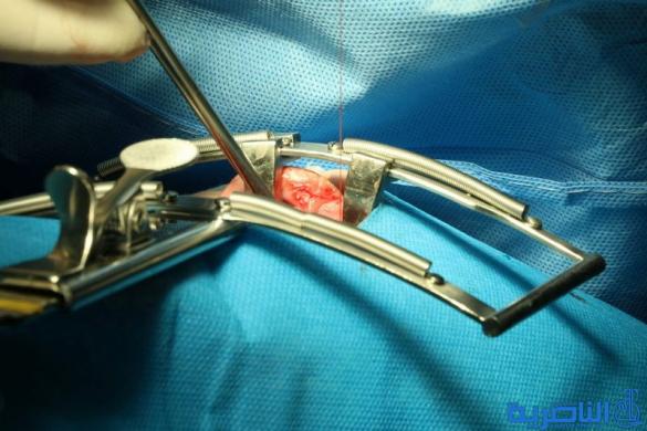فريق طبي ايطالي يباشر باجراء مائة عملية جراحية تجميلية في الناصرية - تقرير مصور -