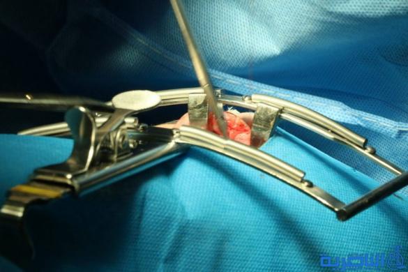فريق طبي ايطالي يباشر باجراء مائة عملية جراحية تجميلية في الناصرية - تقرير مصور -