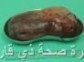 استئصال ورم يزن (2) كغم لامرأة حامل في مستشفى بنت الهدى التعليمي في الناصرية